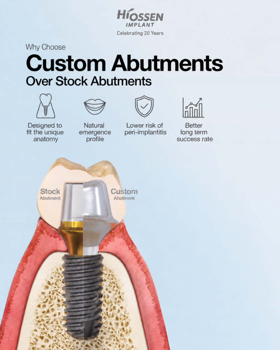 Hiossen illustration comparing stock and custom abutments and describing its implant crown service